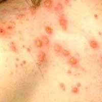 Sức khỏe đời sống - Tử vong do bệnh thủy đậu