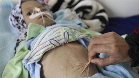 Những đứa trẻ teo tóp đáng thương ở Yemen - 5