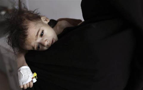 Những đứa trẻ teo tóp đáng thương ở Yemen - 9