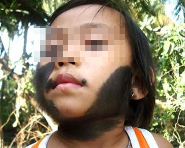 Một bé gái Việt Nam mắc chứng rậm lông đặc biệt.