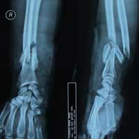 Sức khỏe đời sống - Tuốt lúa, bị cuốn tay vào máy gẫy dập xương