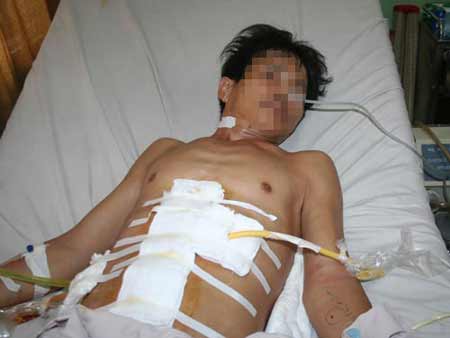 Cứu sống bệnh nhân bị gỗ đâm dập ổ bụng - 2