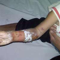 Sức khỏe đời sống - Thuốc nam chữa bỏng: Nhiều trẻ tử vong