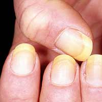 Sức khỏe đời sống - Móng tay bất thường là dấu hiệu bệnh nặng