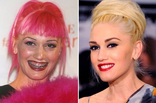 Lộ hàm răng xấu tệ của sao trước thẩm mỹ - 11