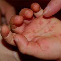 Sức khỏe đời sống - Dấu hiệu nhận biết bệnh tay chân miệng