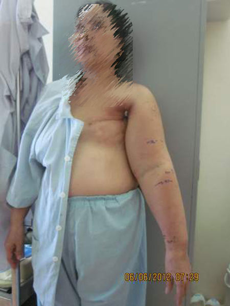 Thoát khỏi nỗi ám ảnh tay voi - 2