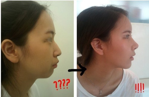 Gái Hàn "hóa thiên nga" nhờ dao kéo - 3