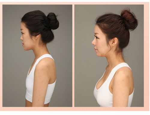 Gái Hàn "hóa thiên nga" nhờ dao kéo - 4