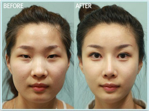 Gái Hàn "hóa thiên nga" nhờ dao kéo - 7