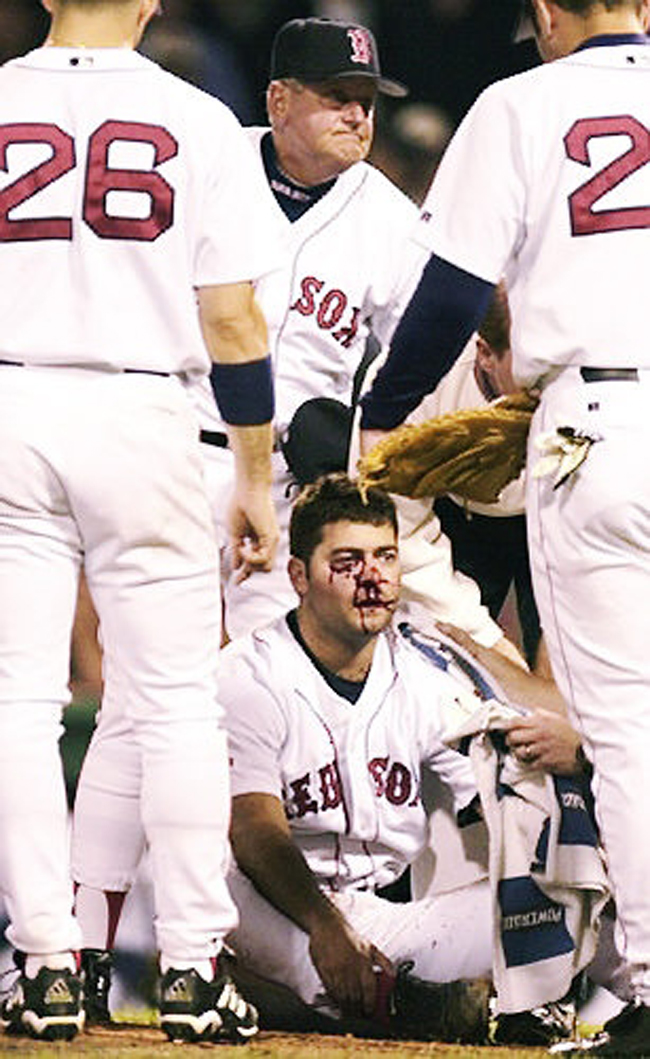 Bryce Florie của đội bóng chày Boston Red Sox với gương mặt đẫm máu sau khi dính trọn cú đánh từ Ryan Thompson của đội Yankee vào năm 2000.