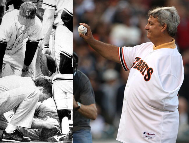 Dave Dravecky của đội bóng chày San Francisco Giants đã gãy tay vào năm 1989 và sau đó phát hiện ra căn bệnh ung thư và phải cưa cánh tay này vào năm 1989.