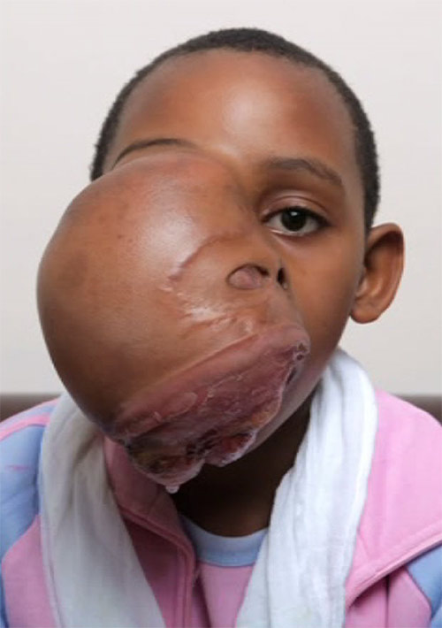 Bé gái mặt như trái bóng được giải cứu - 3