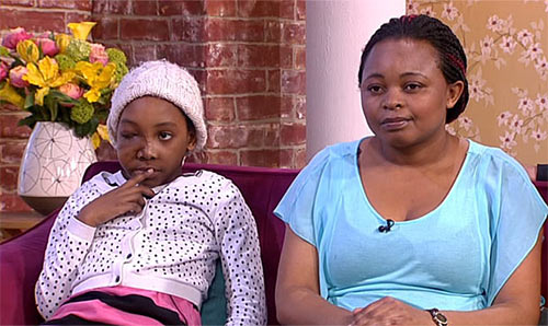 Bé gái mặt như trái bóng được giải cứu - 2