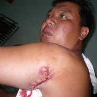 Tin tức trong ngày - “Hiệp sĩ” bị đâm liên tiếp bằng kéo