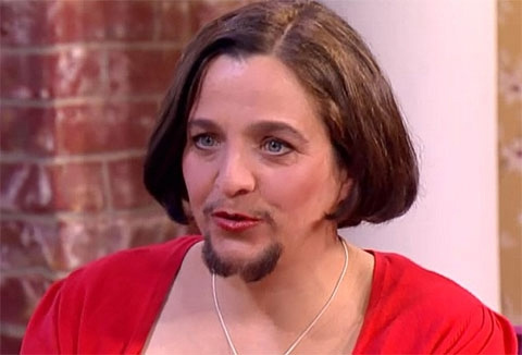 Đức: Người phụ nữ mọc râu như đàn ông - 1