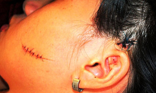 Níu tình hờ, dùng dao lam rạch mặt nữ sinh - 1