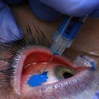 Sức khỏe đời sống - “Xăm tròng mắt”: Kiểu làm đẹp kỳ quái?