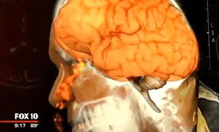 Tưởng bị sổ mũi, hóa ra rò dịch não - 2