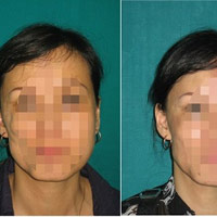 Sức khỏe đời sống - Cô gái có khuôn mặt dị dạng teo tóp