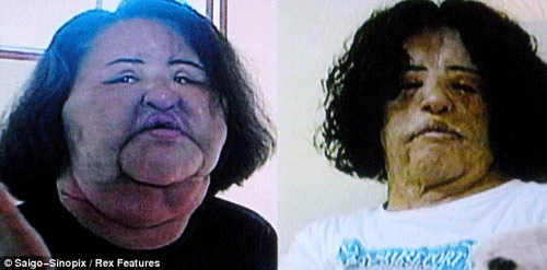 Dị dạng sau khi tự tiêm... dầu ăn vào mặt - 2