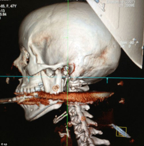 Cô gái xinh đẹp bị lao xuyên từ miệng đến gáy - 1