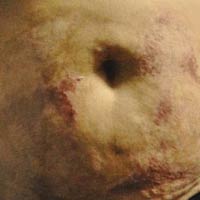 Sức khỏe đời sống - Quái dị chiêu dùng axit, xà phòng để giảm béo