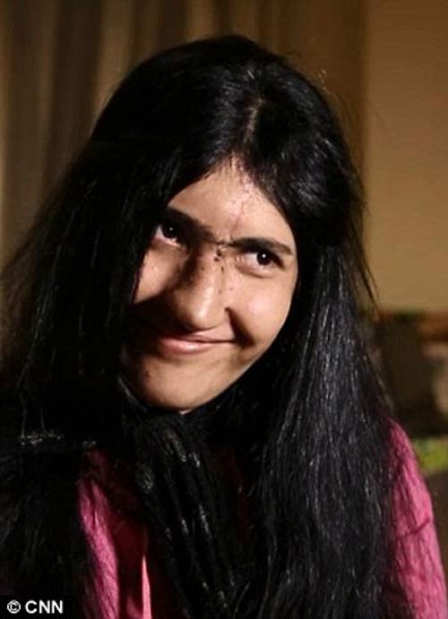Cô gái Afghanistan bị cắt mũi có diện mạo mới - 1