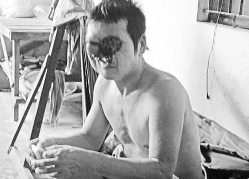 Mang 'mặt quỷ' vì phá mụn ruồi - 1