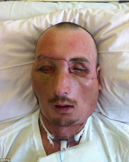 Khuôn mặt mới sau nửa tháng được ghép - 1