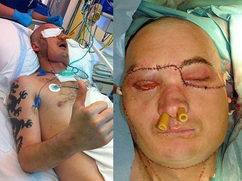 Khuôn mặt mới sau nửa tháng được ghép - 2