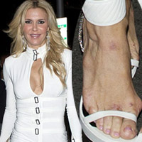 Xu hướng thời trang - Sao Mỹ lộ đôi chân "nham nhở"