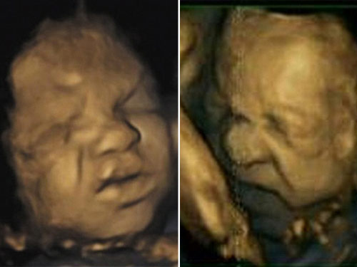 Tận mắt xem hình ảnh thai nhi "cau có" - 1
