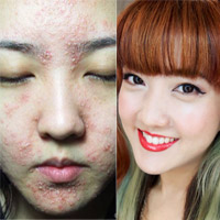 Bí quyết làm đẹp - Sốc với trải nghiệm mặt mụn "cơm cháy"