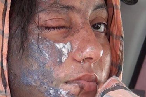 Sao nữ Pakistan bị tạt axit vào mặt - 1