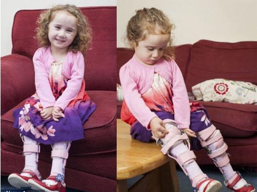 Bước đi đầu tiên của bé gái có "đôi chân ếch" - 2