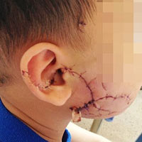 Sức khỏe đời sống - Bé 3 tuổi bị chó cào, cắn nát mặt