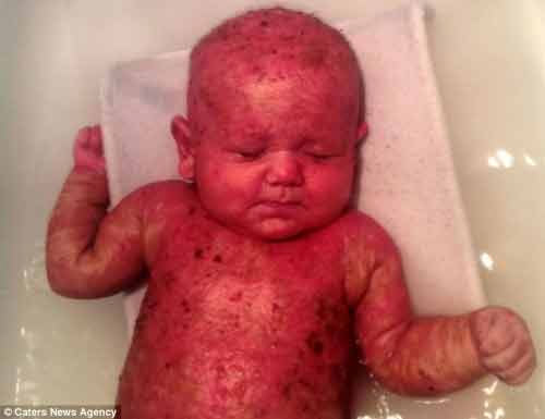 Cậu bé mới sinh đã mắc chứng da bỏng rộp - 1