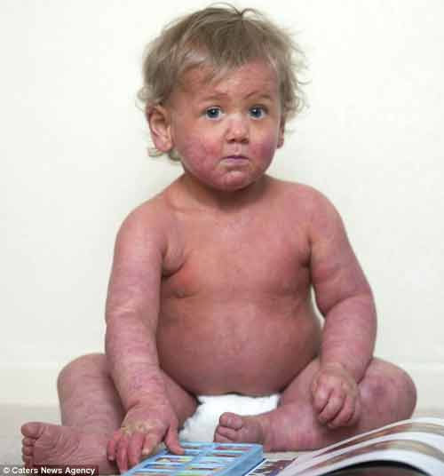 Cậu bé mới sinh đã mắc chứng da bỏng rộp - 2