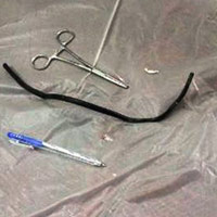 Sức khỏe đời sống - Nuốt đoạn dây điện vào bụng sau 2 năm mới nhớ