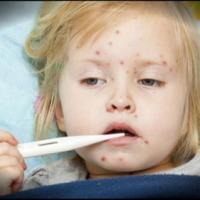 Tin tức trong ngày - Dịch sởi ở Mỹ: Bùng phát từ bệnh viện