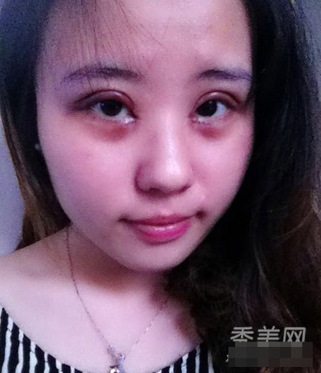Hình ảnh cắt mí sưng húp của cô gái Trung Quốc - 1