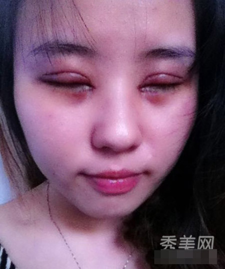 Hình ảnh cắt mí sưng húp của cô gái Trung Quốc - 2