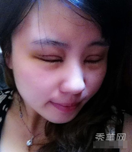 Hình ảnh cắt mí sưng húp của cô gái Trung Quốc - 3