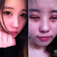 Thẩm mỹ viện - Hình ảnh cắt mí sưng húp của cô gái Trung Quốc