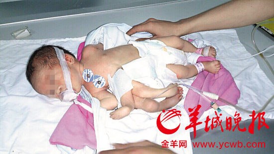 Em bé 8 chân tay ở Trung Quốc - 1