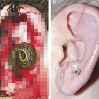 Phi thường - kỳ quặc - Dùng đỉa "nối tai" phục hồi thính giác