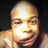 Thể thao - Chấn thương khủng khiếp vì trái bóng chày