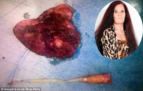 Bác sĩ để quên ống nhựa trong cơ thể bệnh nhân - 1