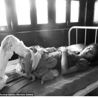 Tin tức trong ngày - Ấn Độ: Không được của hồi môn, chồng thiêu sống vợ